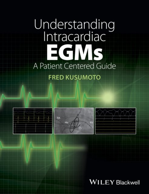 Understanding Intracardiac EGMs – A Patient Centered Guide