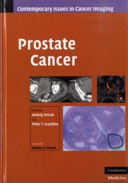 Prostate Cancer