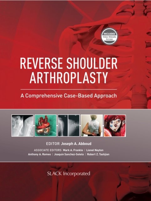 Reverse Shoulder Arthroplasty