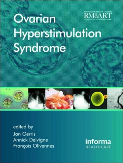 Ovarian Hyperstimulation Syndrome
